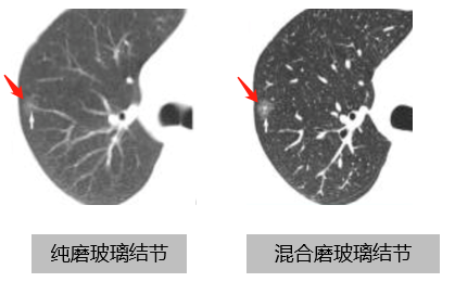 磨玻璃结节.png