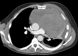 Non-seminomatous germ cell tumors.jpg