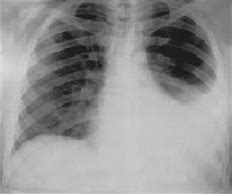 Hemothorax2.jpg