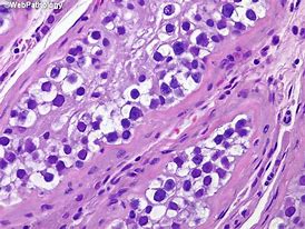 Testicular germ cell tumors1.jpg