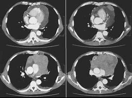 Anterior mediastinal germ cell tumors.jpg