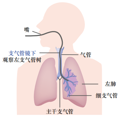 支气管镜.PNG