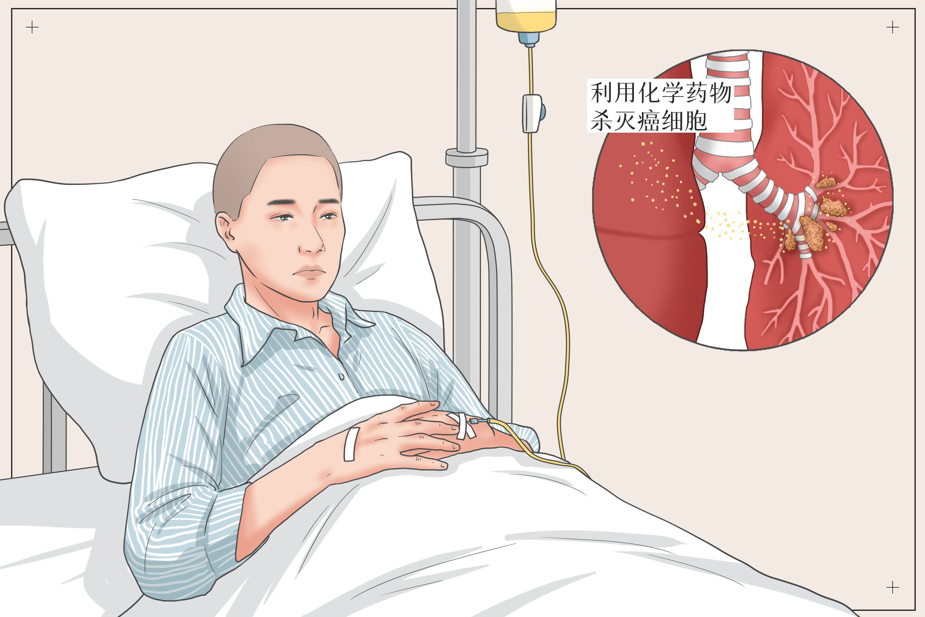 摄图网_401803185_肺癌化学治疗医疗插画（企业商用）.jpg