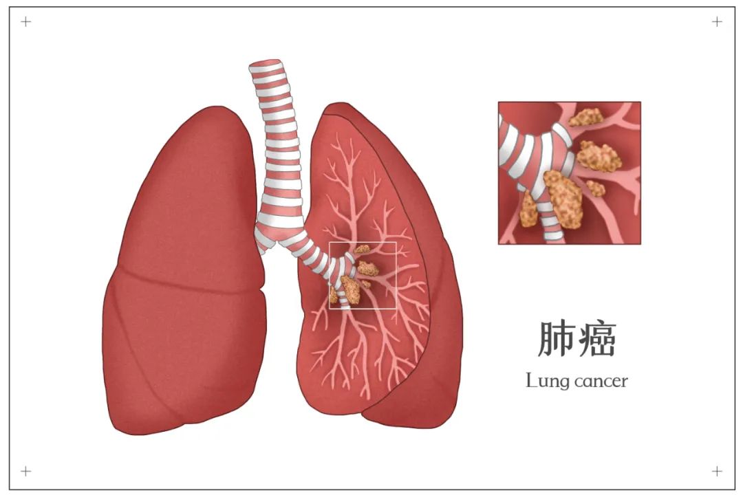 肺癌到底是什么？